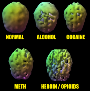 addiction effect on brain